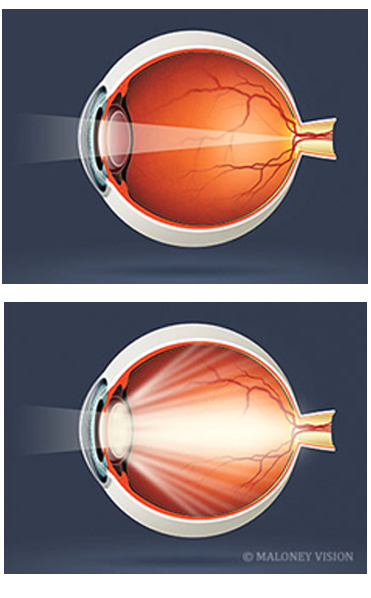 Cataract Surgery