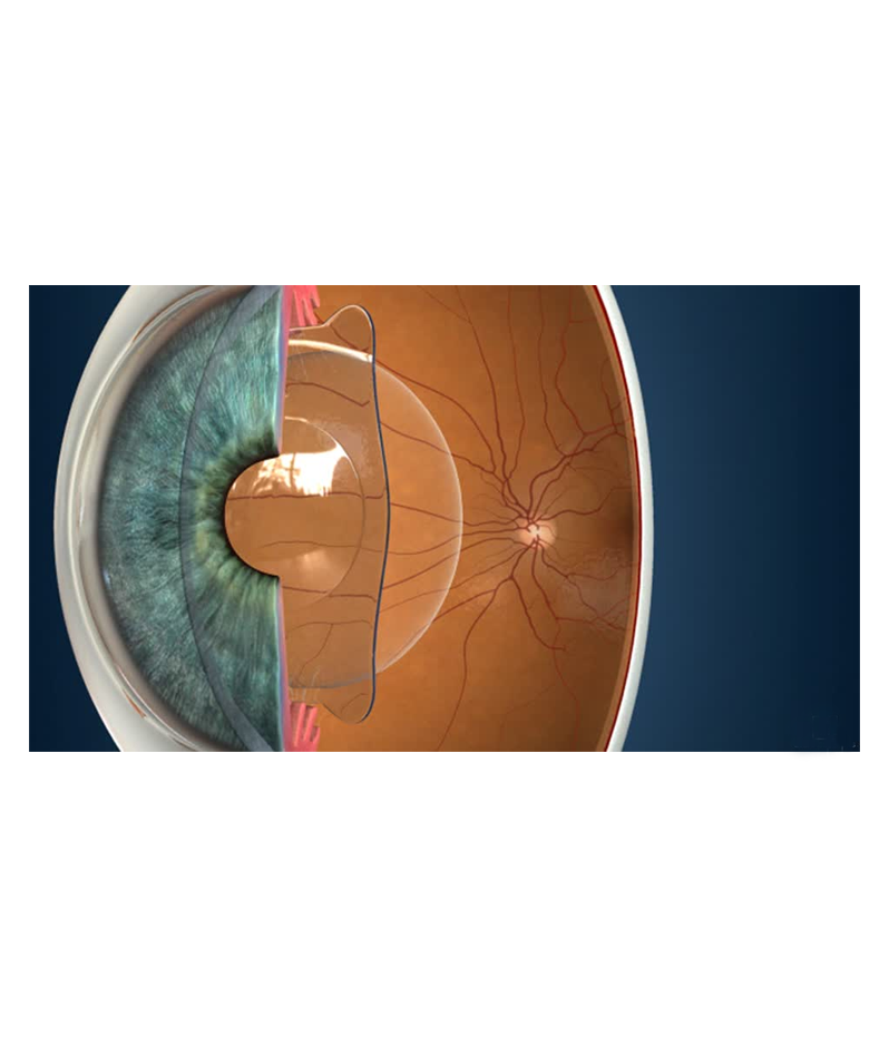 Implantable Collamer Lens