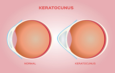 Keratoconus