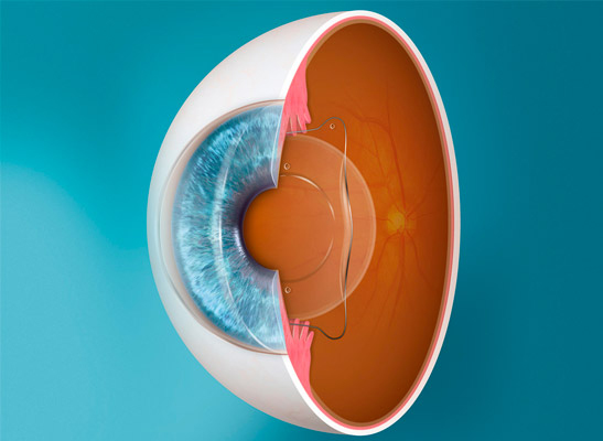 LASIK Eye Surgery Los Angeles